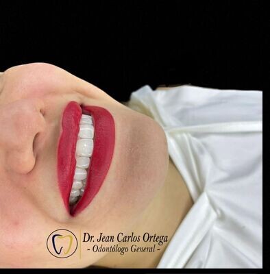 Diseño de sonrisa