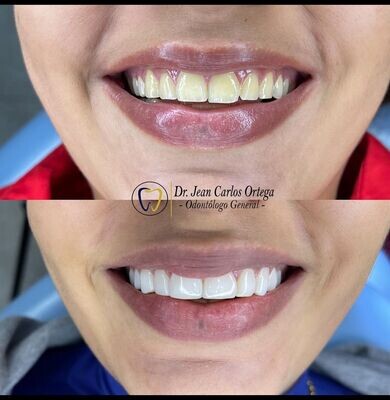Diseño de sonrisa