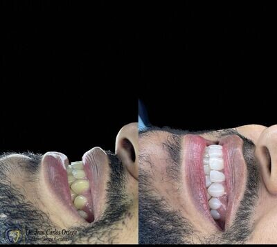 Diseño de sonrisa