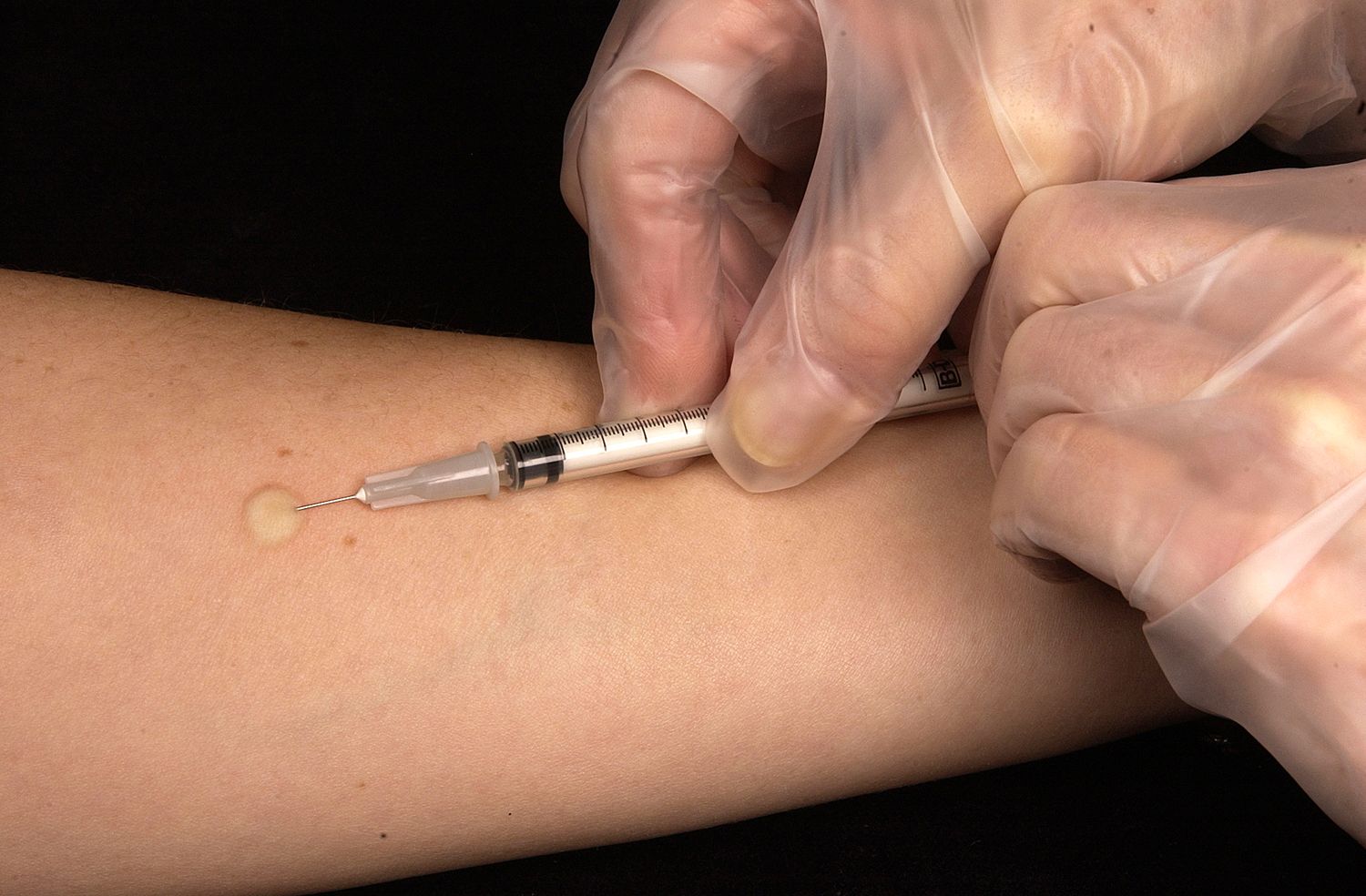 MANTOUX