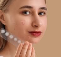 Acne Patch