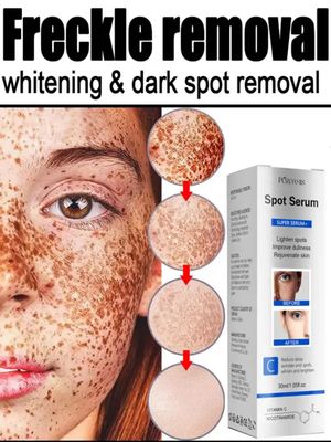 Freckle Removal Whitening Essence Liquid Decompose Melanin Fade Dark Spots Melasma Treatment Brighten