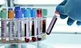 Babesia Microti IgG & IgM Coinfection Babesia Microti IgG & IgM Coinfection