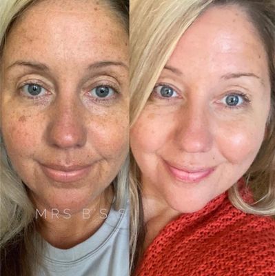 180° AHA Facial Peel and Neutralizer