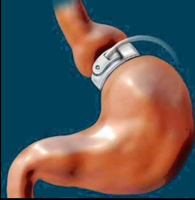 Hypnotic Virtual Gastric Band