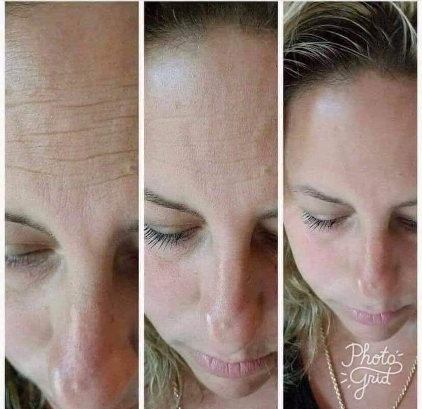 Tru Face Line Corrector