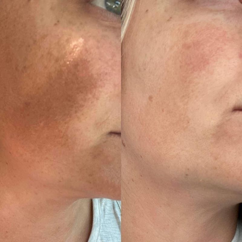 180 Facial Peel &amp; Neutralizerr