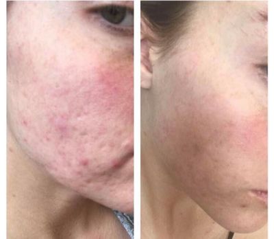 180 Facial Peel &amp; Neutralizerr