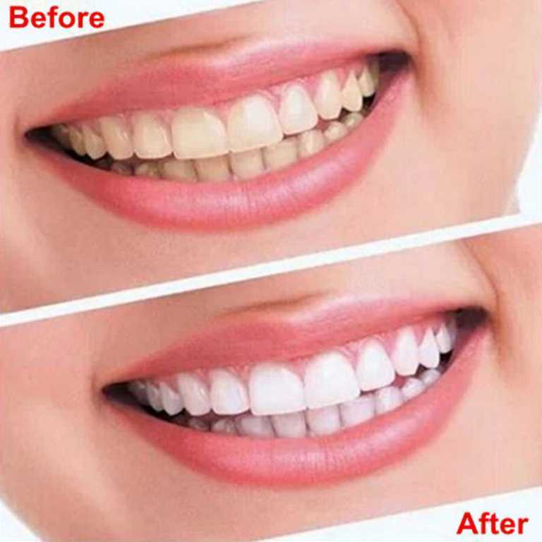 Dental 360° Advanced Teeth Whitening Strips