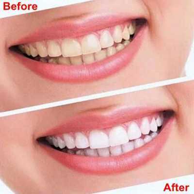 Dental 360° Advanced Teeth Whitening Strips