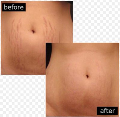 Stretch Marks set