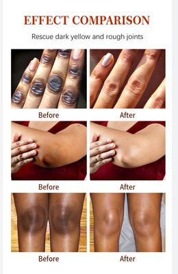 Knuckles remover set