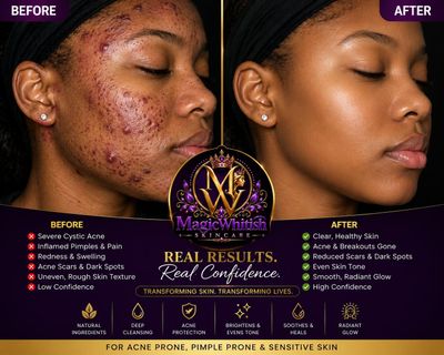 Acne&amp;pimples face treatment