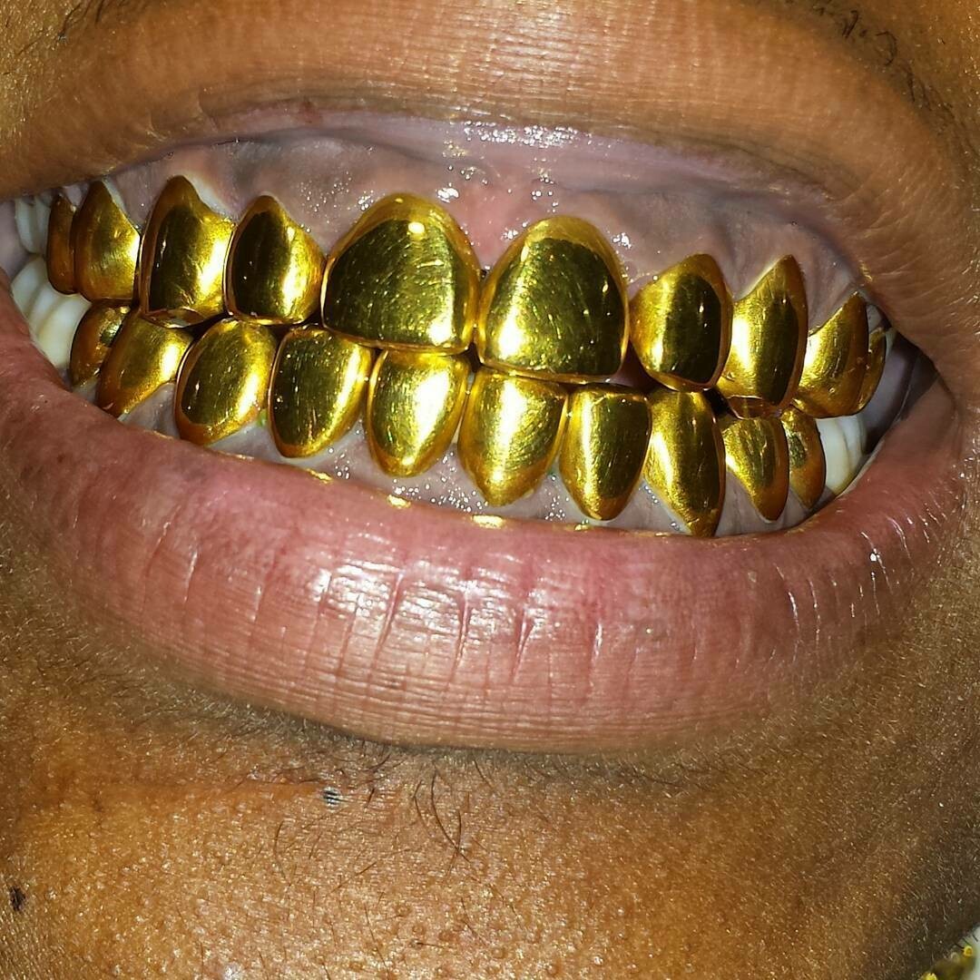 Permanent gold teeth with diamonds best sale