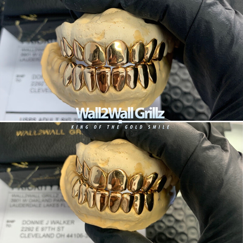 22K Gold (Permanent Crowns)