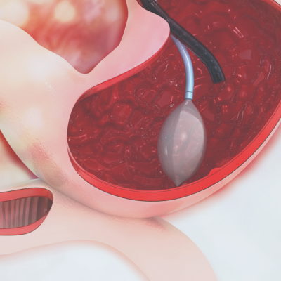 Gastric Balloon Holiday Package