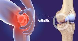 Hair Analysis: Arthritis