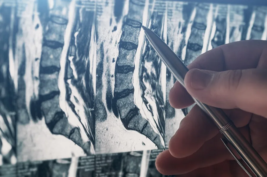 Lumbar Spine X-Ray Lumbar Spine X-Ray