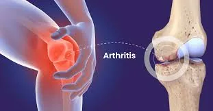 Knee pain, deterioration, and arthritis