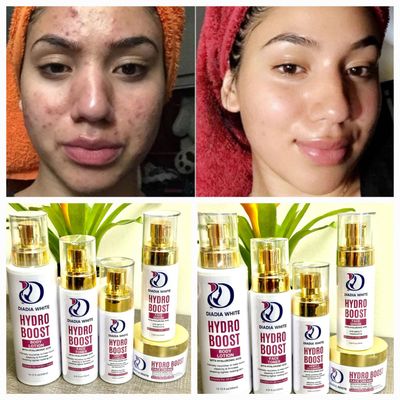 hyaluronic acid skin care products face cream serum moisturizing anti aging set