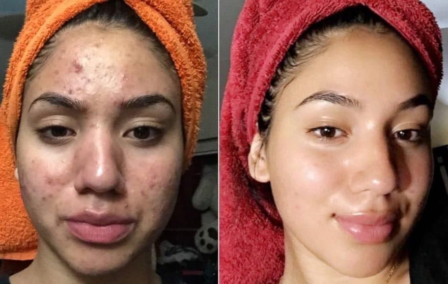 hyaluronic acid skin care products anti aging Acne Dark Spot Removal