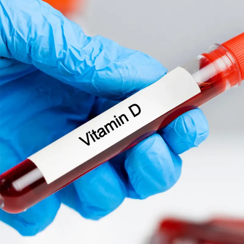 Vitamin D (25-DiHydroxyvitamin D) Lab Test