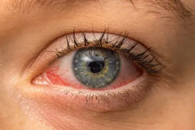 Red Eye Appointment