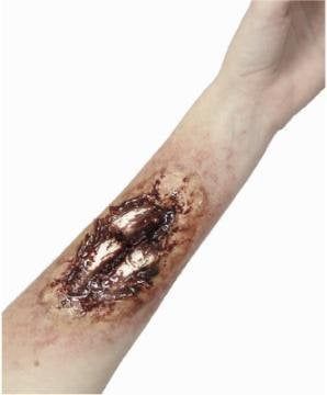 Compound Fracture