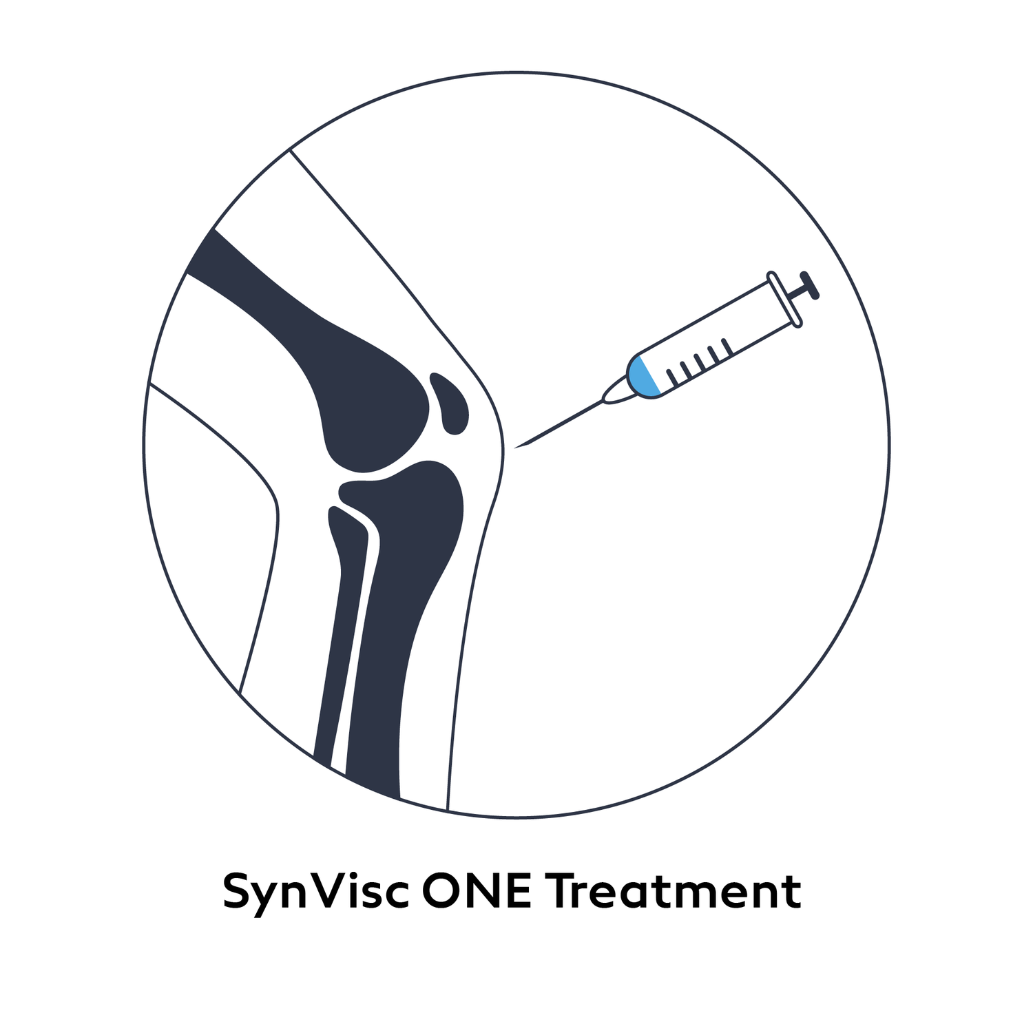 Knee Injection for Pain (SynVisc ONE Hyaluronic Acid)