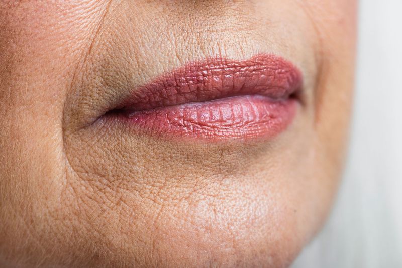 Soin des lèvres au collagène avec endermolift LPG