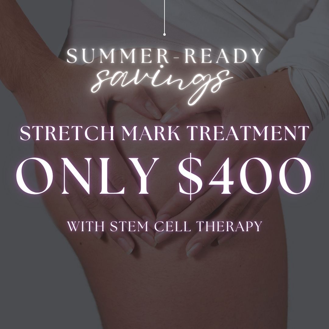 Stretch Mark Treatment | Anteage Stem Cell Therapy