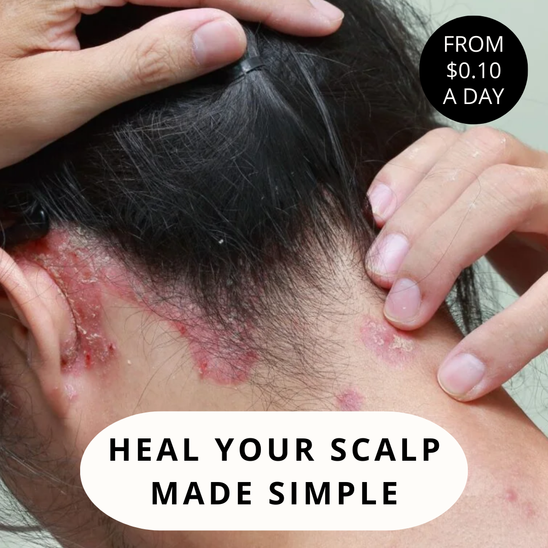 Scalp Care For Your: Psoriasis, Eczema, Itching, Sores, Scabs & Dandruff - 10 Minute Miracle - Complete Bundle Scalp Care For Your: Psoriasis, Eczema, Itching, Sores, Scabs & Dandruff - 10 Minute Miracle - Complete Bundle