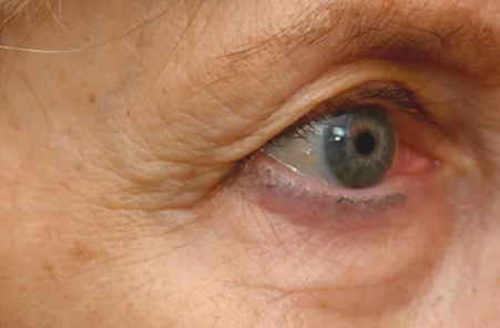 Pelleve Periorbital (eyes)