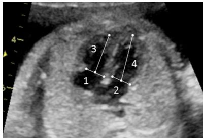 Ecocardiograma Fetal