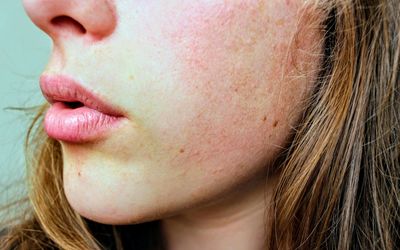 Dry & Dehydrated Skin