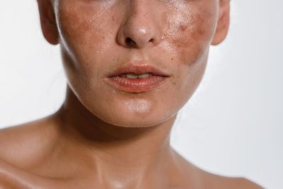 Hyperpigmentation & Dark Spots