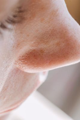 Enlarged Pores