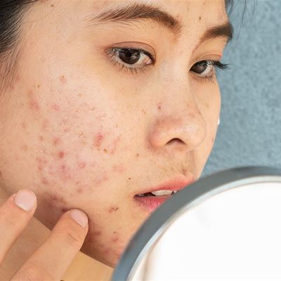 Acne & Blemishes