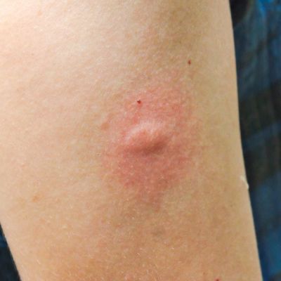 Bites