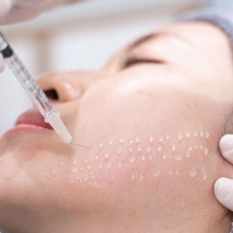 Fillers en Mesotherapie