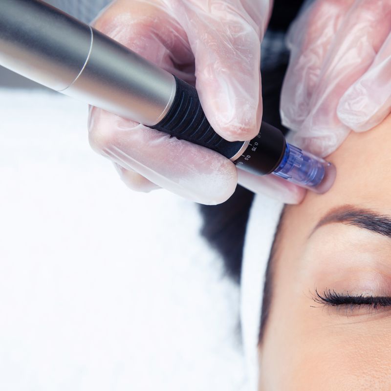 Microneedling