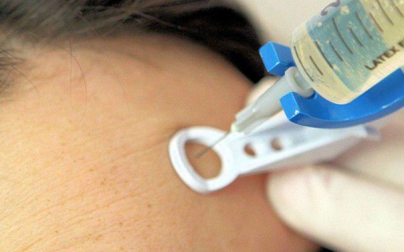 VIP-behandeling voor je huid: ontdek de kracht van mesotherapie en fillers