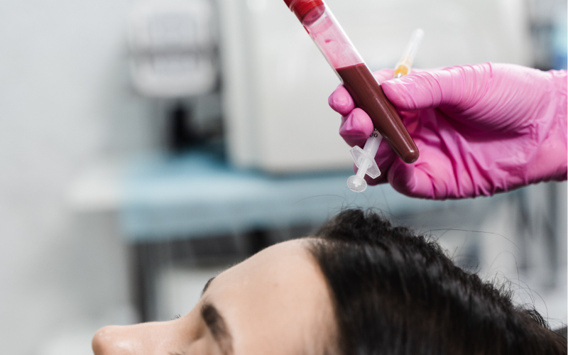 PRP Plasma Behandelingen/Vampire Facelift