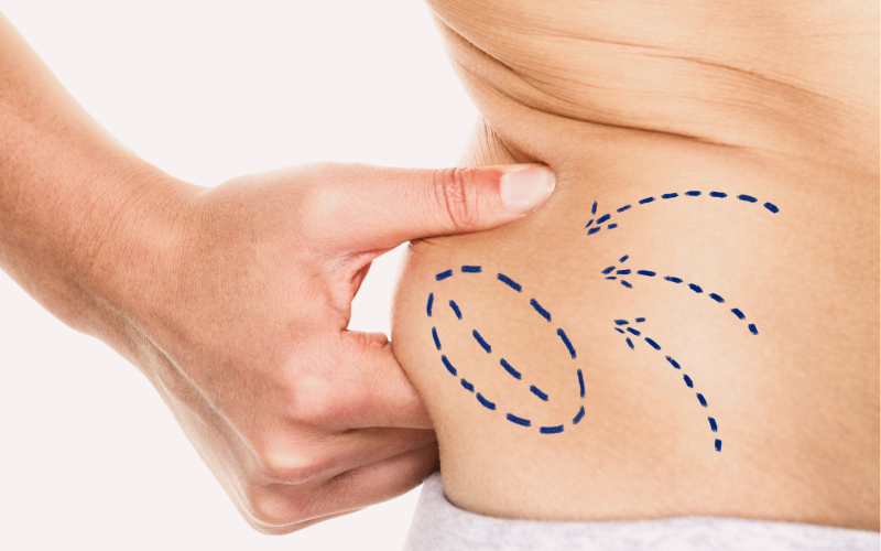 Lipo Laser