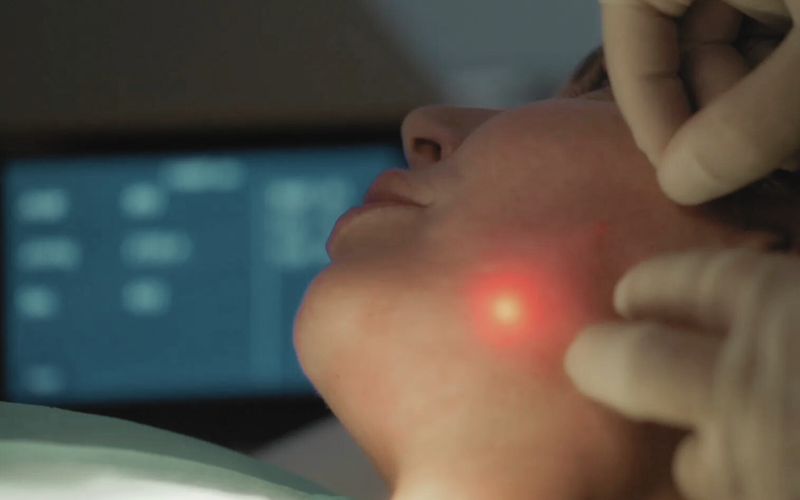 Endolift