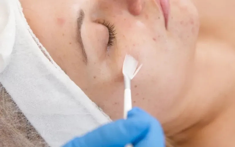 TCA Peeling