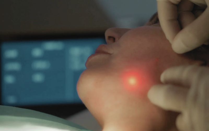 Endolift
