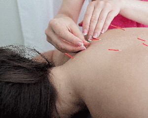 Acupuncture Treatment (Initial)