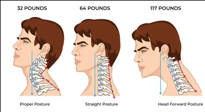 Cervical posture comparison graphic