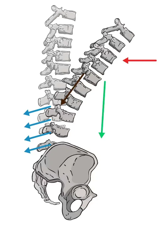 Spinal diagram with posterior shear in bad posture
